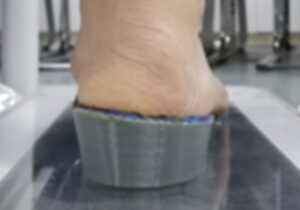 IEMAI3D - 3D printed rehabilitation orthopedic insole