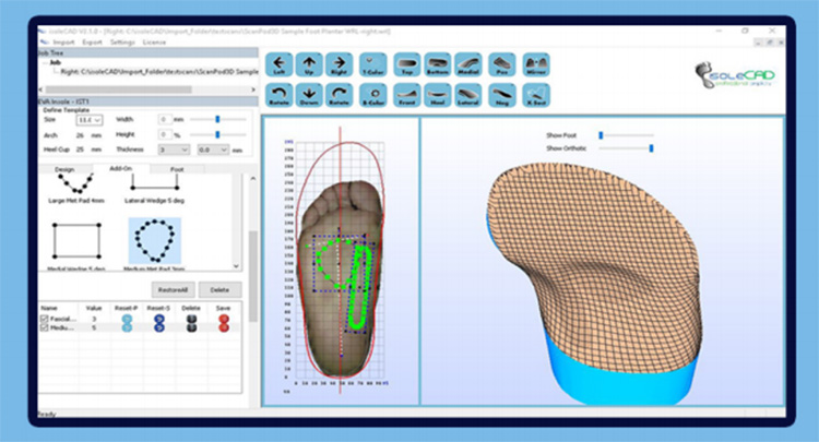IEMAI3D - 3D printed rehabilitation orthopedic insole